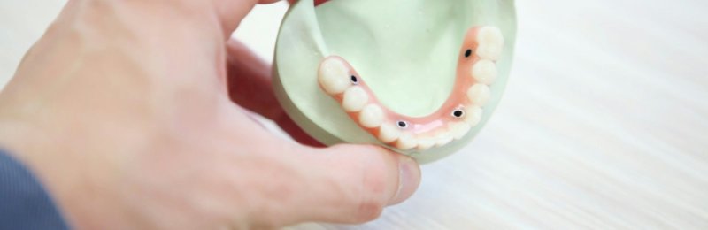 牙结石 Dental calculus