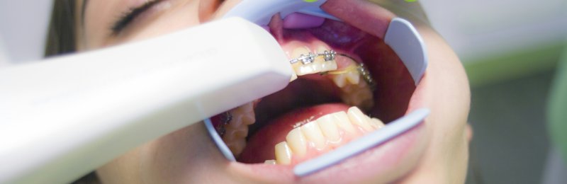洗牙 teethwashing